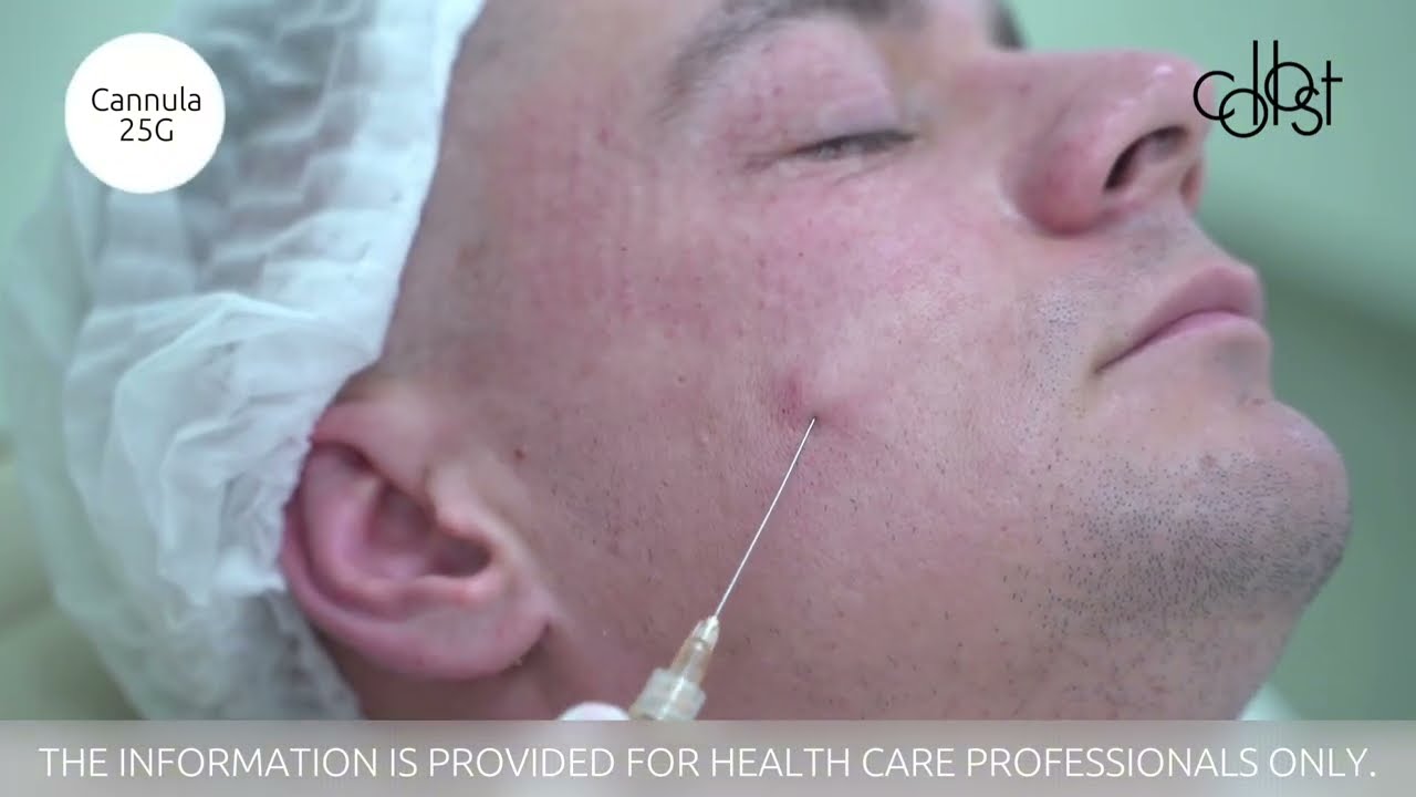 Workshop on Use of COLLOST® 15% Collagen Material with Cannula and Needle