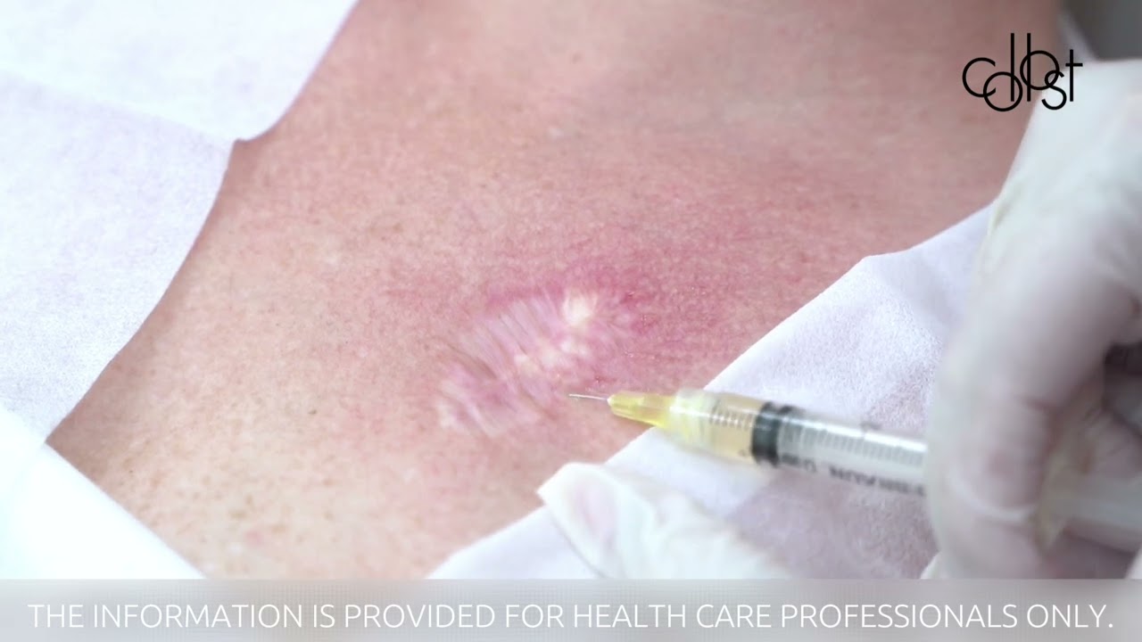 Workshop on Scar Correction Using COLLOST® 7% Collagen Complex. Step-By-Step Guide