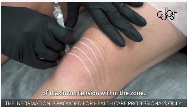 Workshop on Correction of Age-Related Changes in the Knee Area Using COLLOST® micro