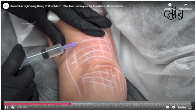 Workshop on Correction of Age-Related Changes in the Elbow Area Using COLLOST® micro